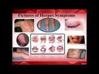 Is Herpes Curable? How to Get Rid of Herpes Naturally in 1 Week! - Herpes Cure