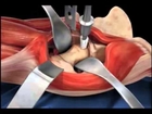 Total Hip Replacement Animation- USMLE Videos